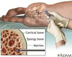 bone marrow aspiration medlineplus