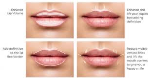 5 ways to love your lips with filler