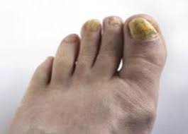 onychomycosis board certified foot