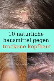 Von dermatologen und apothekern weltweit empfohlen. 19 Schuppenflechte Ideen Schuppenflechte Haare Pflegen Schuppen Haare