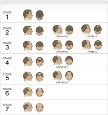 Hair Loss In Men Vivandi One Stop Solutions For Hair