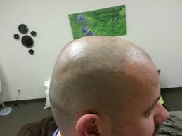 scalp micropigmentation cause hair loss