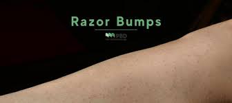 what are razor ps how to treat