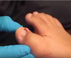 infected ingrown toenail removal by dr