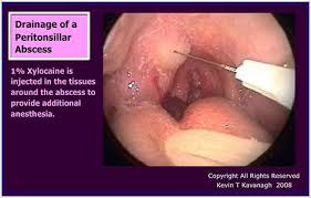 peritonsillar abscess quinsy surgical
