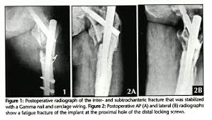 multiple gamma nail failure orthopedics