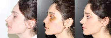 swelling of the nose after rhinoplasty