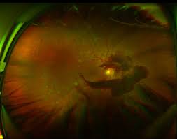 vitreous hemorrhage loss of vision