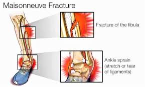 Normal >1 mm on mortise view Maisonneuve Fracture Definition Causes Symptoms Diagnosis Treatment