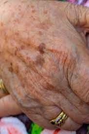 manchas oscuras en la piel causas