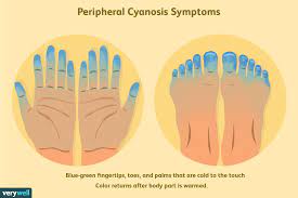 peripheral cyanosis symptoms causes