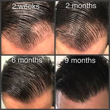This procedure requires stitches that. Hair Transplant Timeline Marc Dauer Md Hair Transplant Doctor Los Angeles