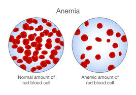 Hasil carian imej untuk anemia causes of thirsty