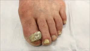 topical therapy for onychomycosis