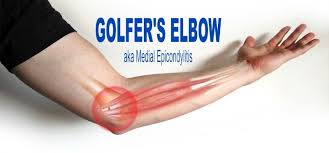 golfer s elbow aka al epicondylitis
