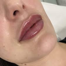 lip fillers injex clinics
