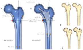 bone morphology of the proximal fem