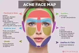 cheek acne what it means how to