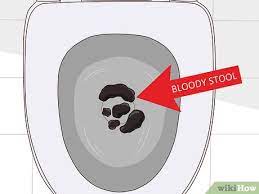 how to treat a bleeding ulcer 14 steps