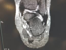 The studies were performed on a variety of magnets ranging from 0.2 to 1.5 t between march 15 and july 22, 2006. A Closer Look At Imaging Options For Complicated Heel Pain Podiatry Today