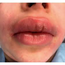 prominent upper lip swelling with