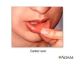 how to treat and prevent mouth ulcers