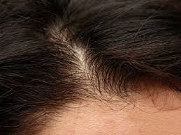 what your hair loss is trying to tell