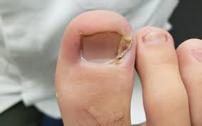 what are ingrown toenails