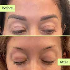 permanent makeup removal laser removal