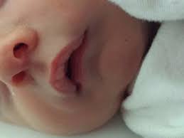 baby s upper lip dry and swollen