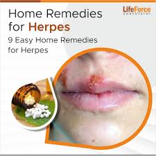 9 easy home remes for herpes lifeforce