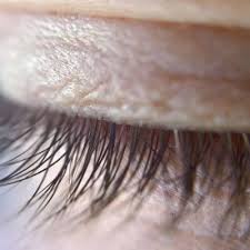 get rid of a stye on your eyelid