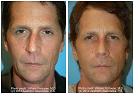 Check spelling or type a new query. Wide Nasal Bones Before And After Photo Gallery Nose Surgery Photos