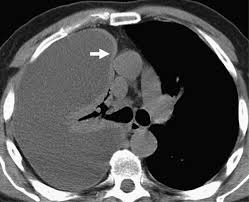 To get positive findings in the erect position there. References In Malignant Pleural Mesothelioma Computed Tomography And Correlation With Histology European Journal Of Radiology