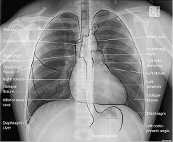 An online course by lee herrington. Normal Chest X Ray Litfl Medical Blog Labelled Radiology