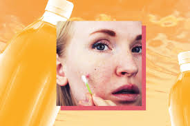 apple cider vinegar acne how to use