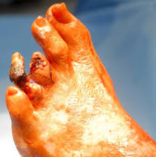 Image result for amputated foot