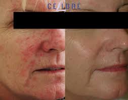 laser treatment for rosacea cost