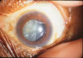 Cortical Cataract Precision Family Eye Care