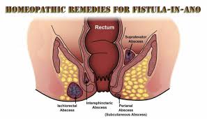 homeopathic remes for fistula in ano