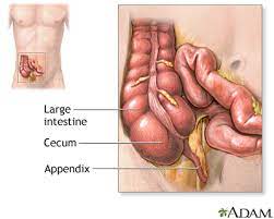 appendicitis information mount sinai