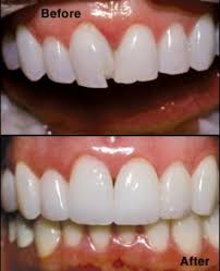 Anesthesia is usually not needed unless there is an old restoration or decay present. Dental Bonding In Charlotte