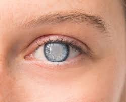 cataract mehta international eye