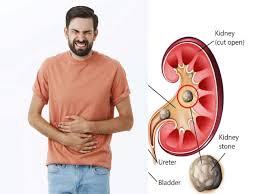 recur kidney stones