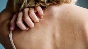 8 common types of rashes everyday health