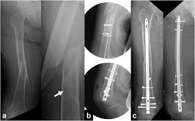 infra isthmal fem fracture