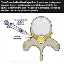 epidural steroid injections