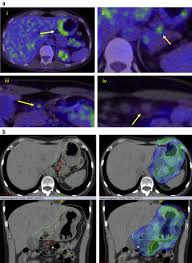 involved site radiation therapy in