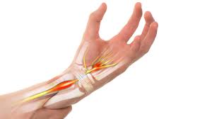 Carpal Tunnel Settlements For Injured Workers Rosenfeld