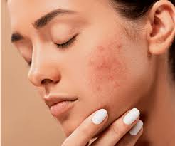 lutter contre l acné hormonale cyne